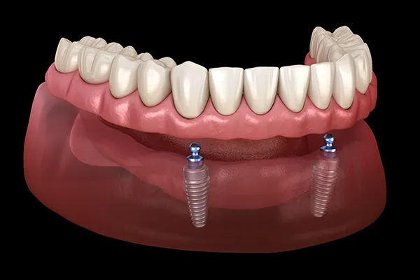 Ball attached denture diagram at Durham Prosthodontics.