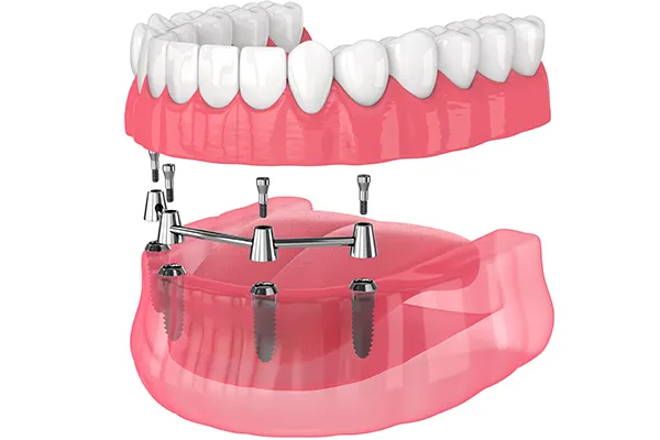 Bar attached denture diagram at Durham Prosthodontics.