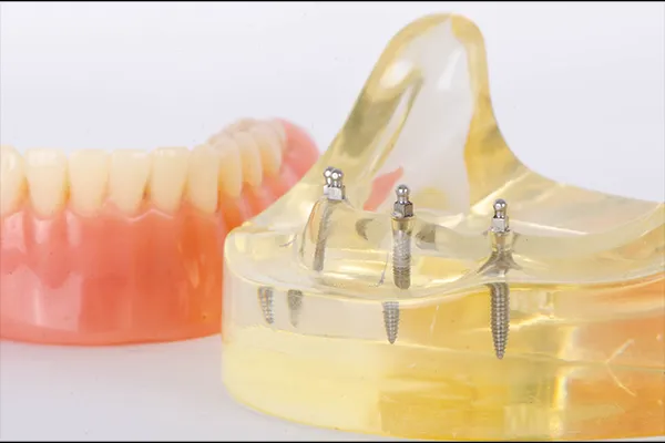 Screw Reatined denture diagram at Durham Prosthodontics.