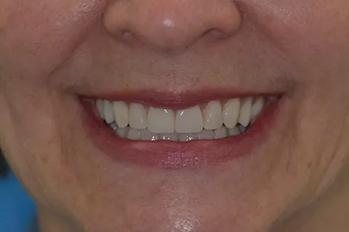 After smile of a patient