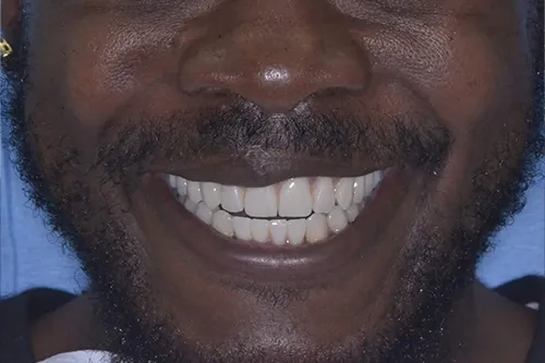 Full mouth restoration After smile