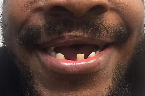 Full mouth restoration Before smile