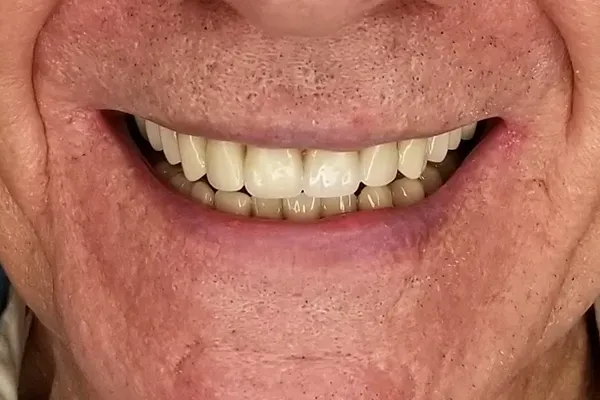 Full mouth restoration After smile