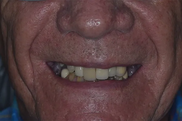 Full mouth restoration Before smile