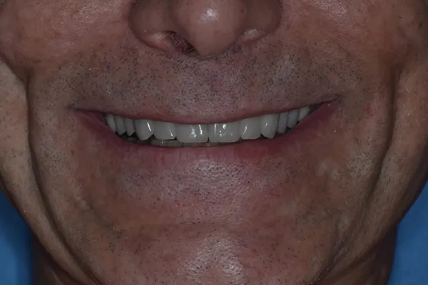 Full mouth restoration After smile