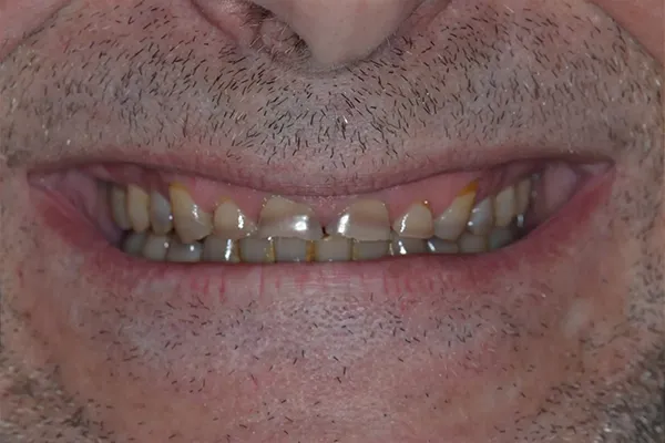 Full mouth restoration Before smile