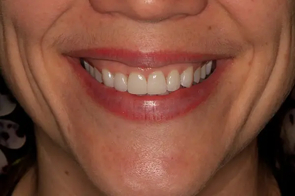 Cometic dentistry After smile