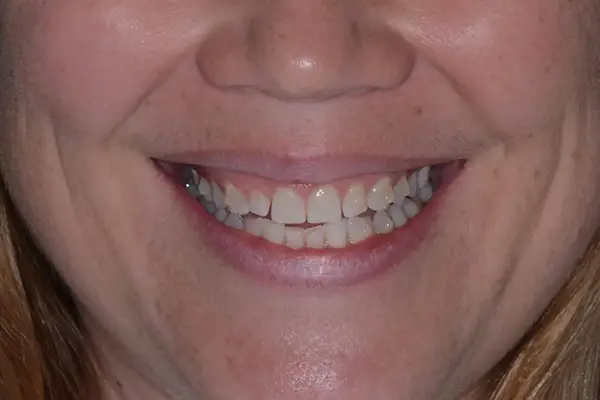 Cometic dentistry Before smile