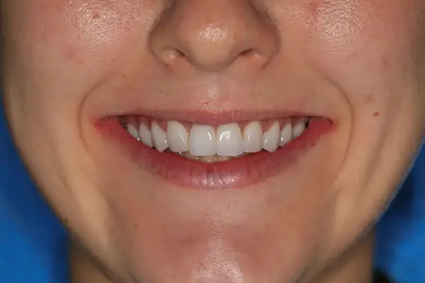 Cosmetic dentistry After smile