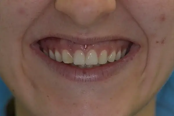 Cosmetic dentistry Before smile