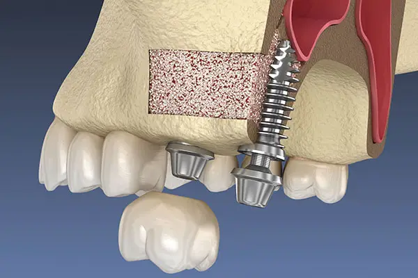 A diagram of grafting with implant in a space of missing tooth.