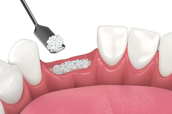 A diagram of grafting in a space of missing tooth.