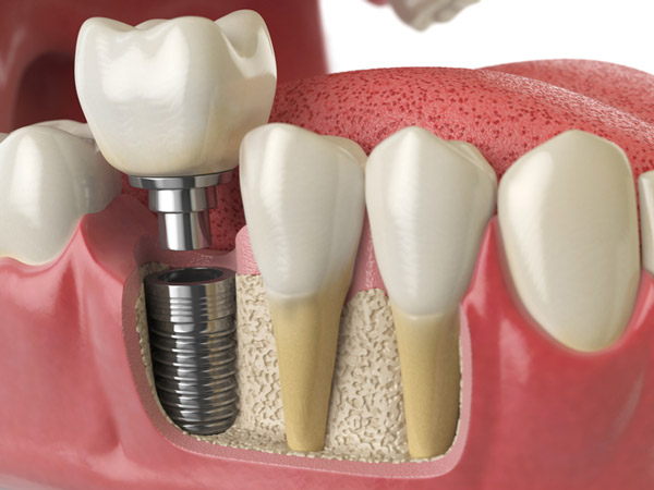  Diagram of dental implant in to jaw bone.