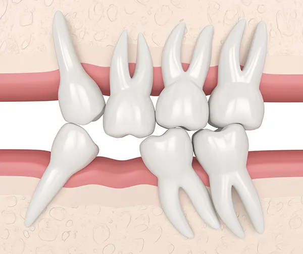 Seven misaligned and crooked teeth crowding the empty space where a missing tooth should be