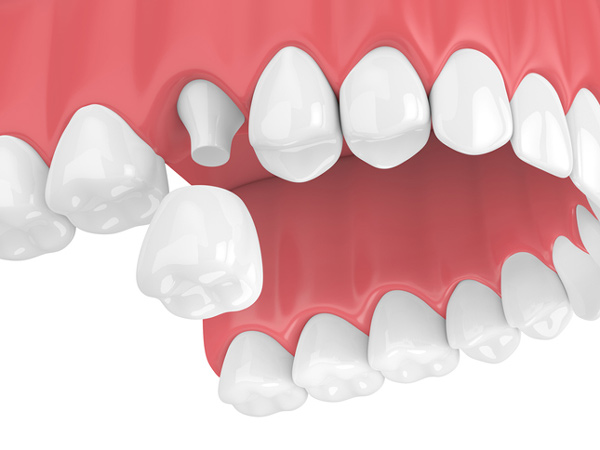 Rendering of jaw with dental crown.