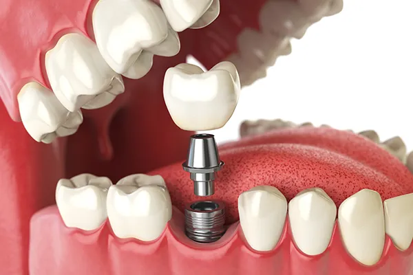 A dental implant being placed, showing the implant post, abutment, and crown in a jaw model.