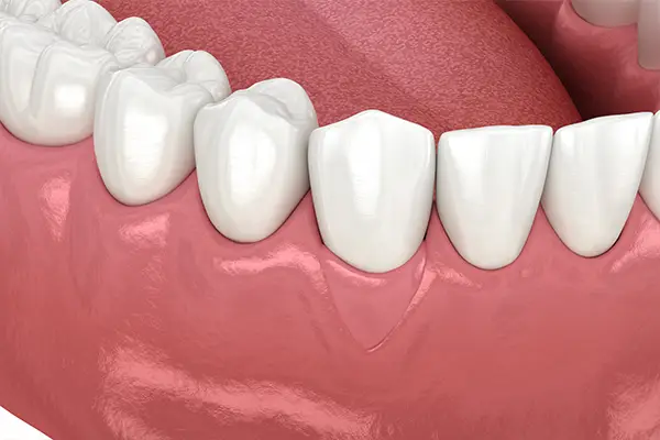 Gums fully restored after a successful procedure, showcasing healthy tissue.